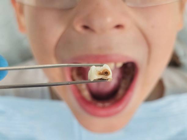 Best Broken or Cracked Tooth Emergency Dentist in Montpelier, VT